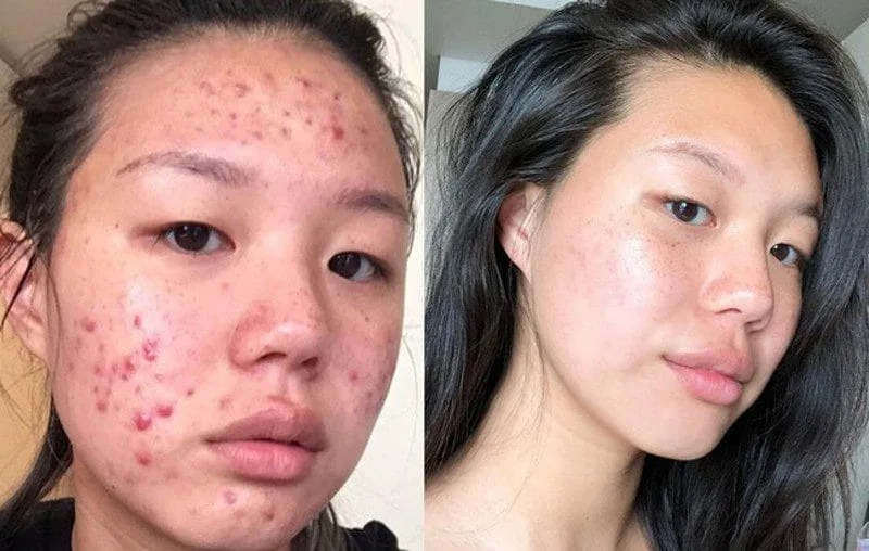 Địa chỉ nặn mụn uy tín tại Gò Vấp