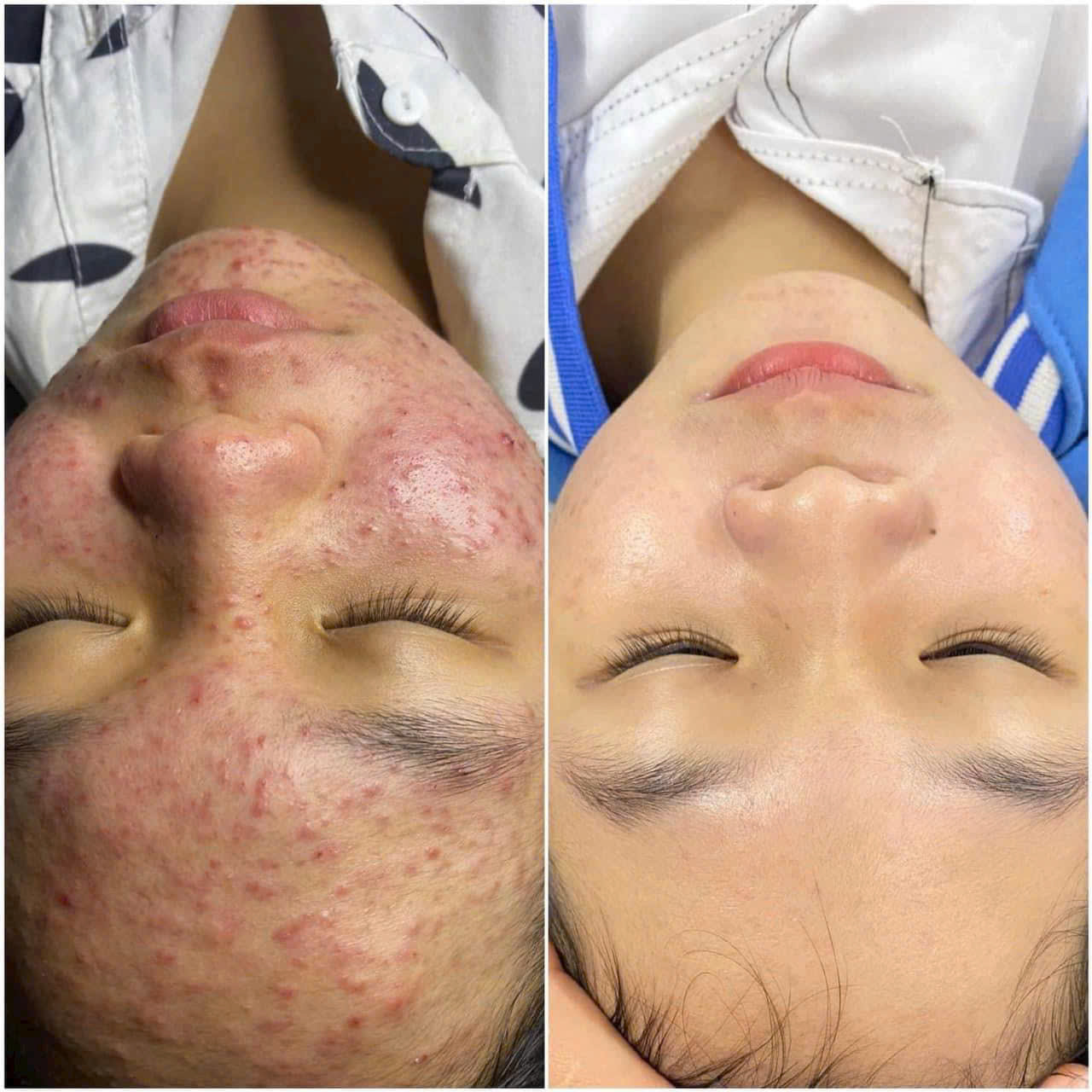 Chemical Peel