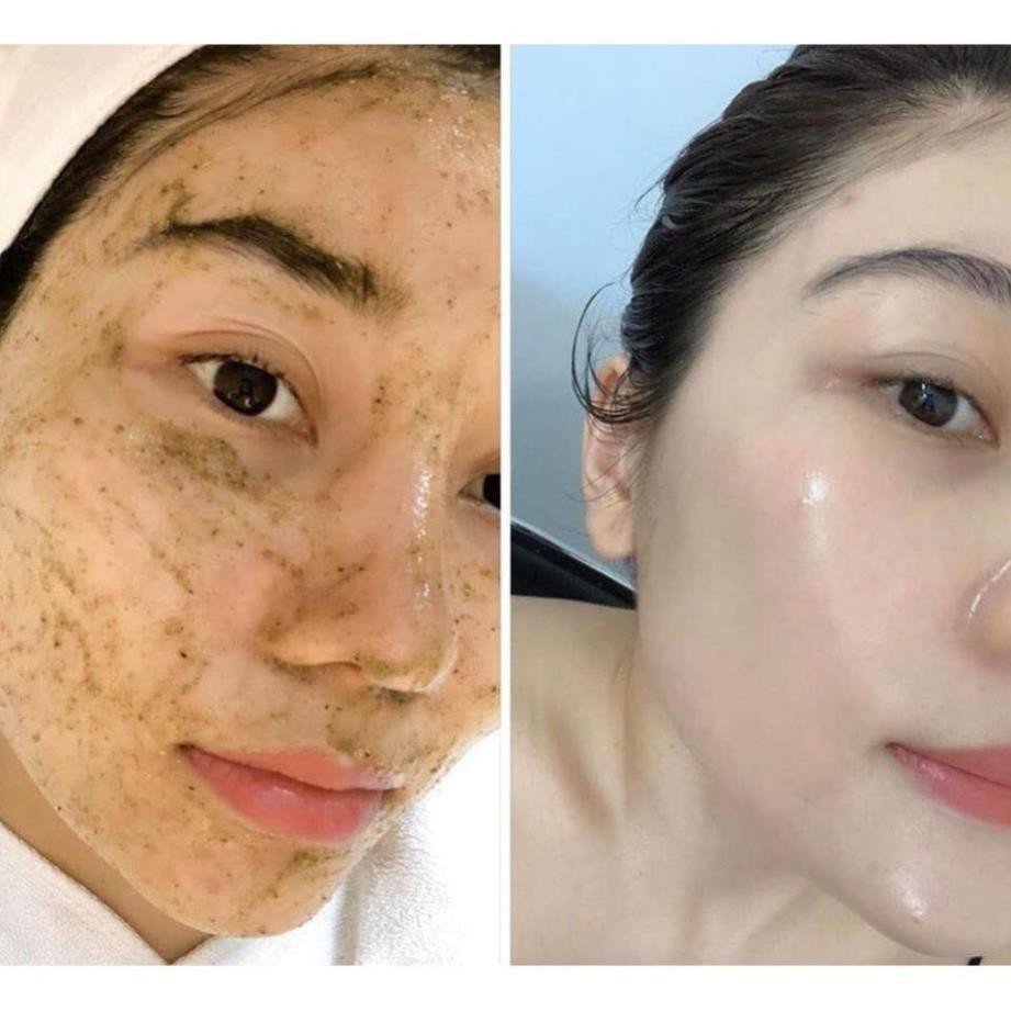 Dịch vụ peel da trị mụn tận gốc