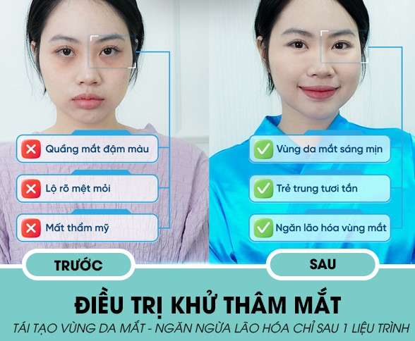 Điều trị khử thâm mắt