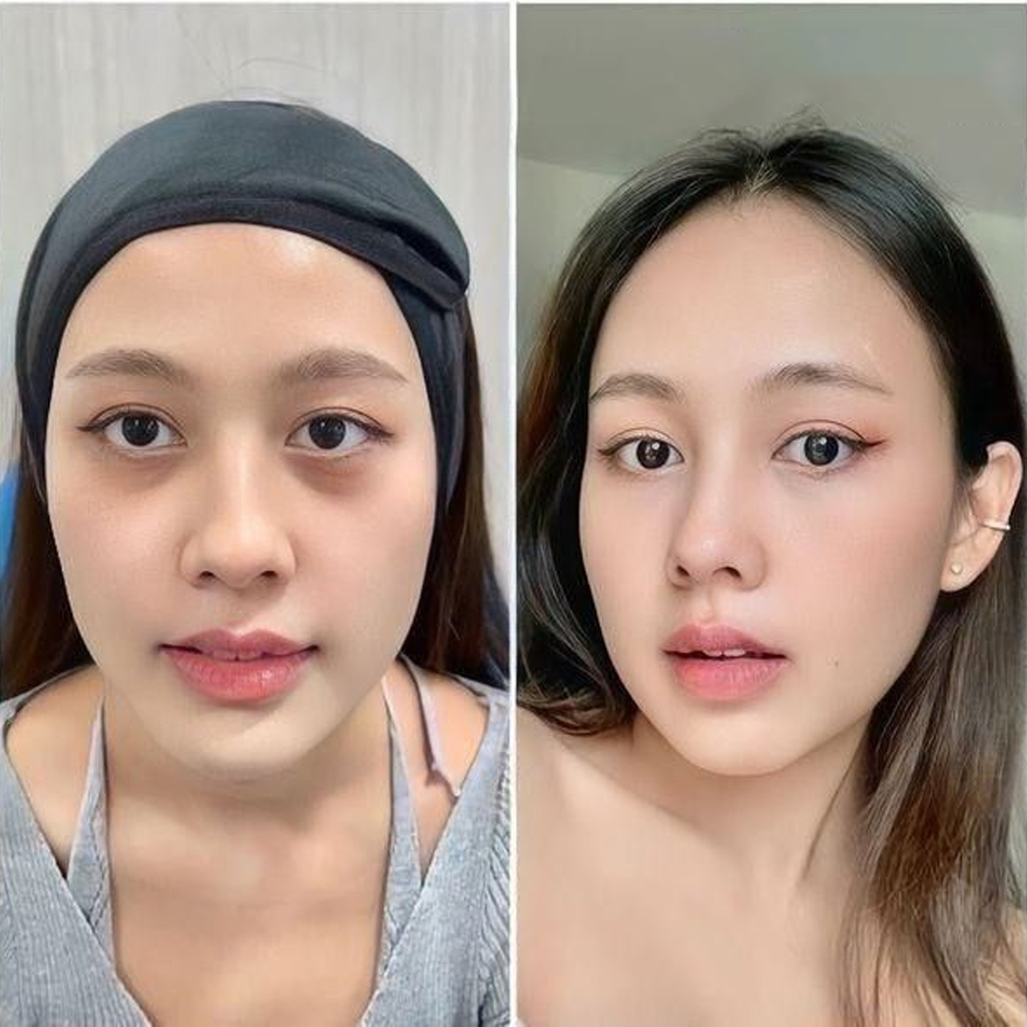 Điều trị khử thâm mắt