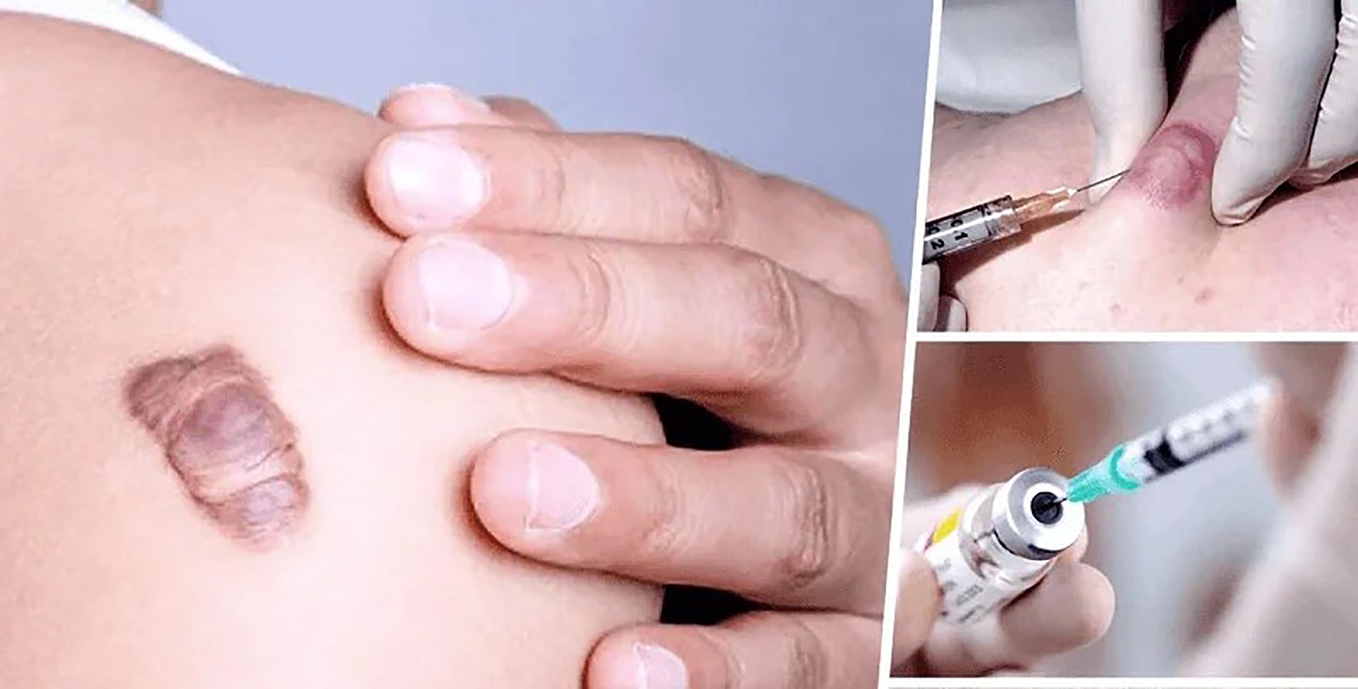 Điều trị tan sẹo lồi