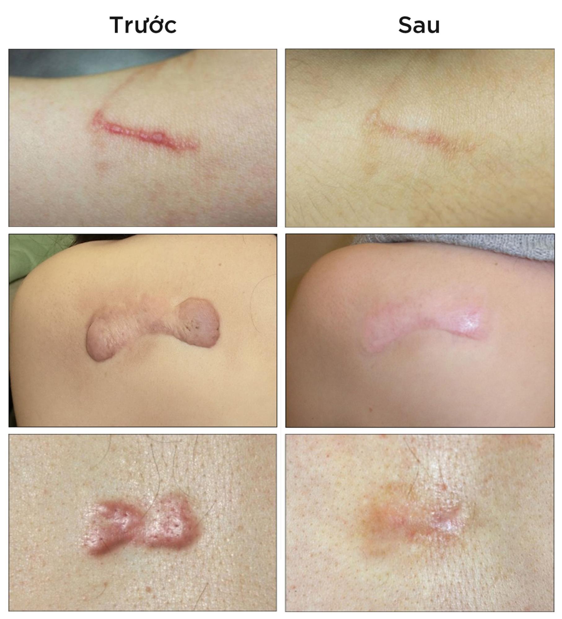 điều trị sẹo lồi