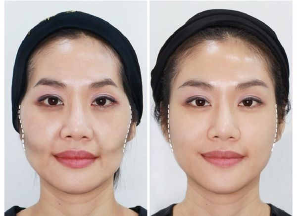 khắc phục thái dương hóp