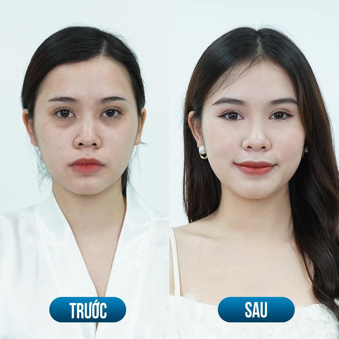 trị thâm mắt