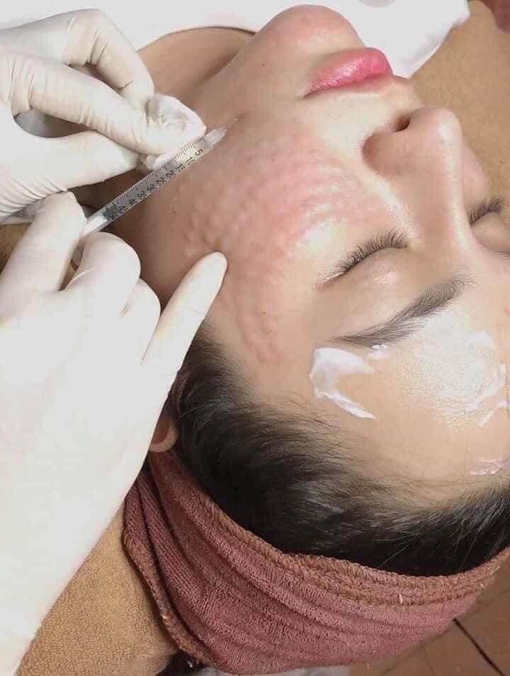 Dịch vụ tiêm Meso