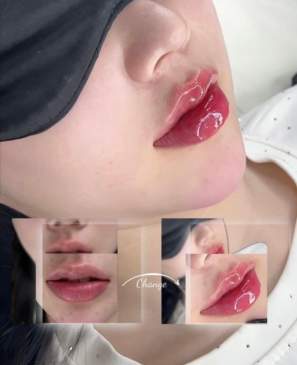 Địa chỉ tiêm filler uy tín