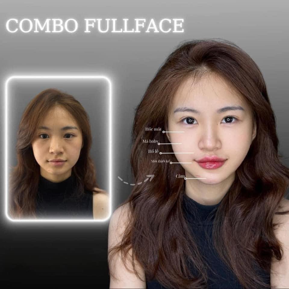 Địa chỉ tiêm filler uy tín
