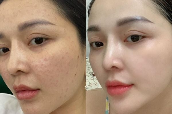 Công nghệ Mesotheraphy