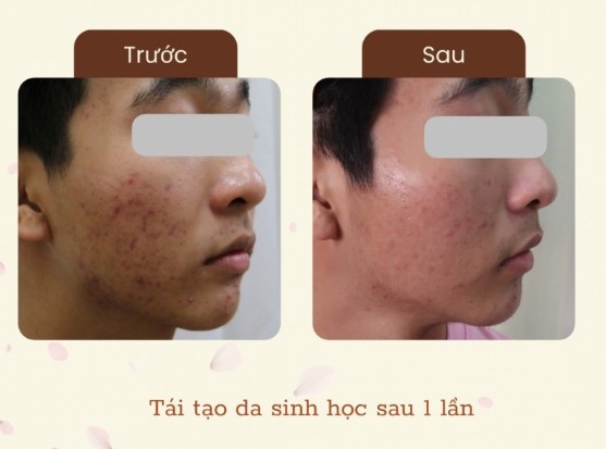 Chemical Peel 2