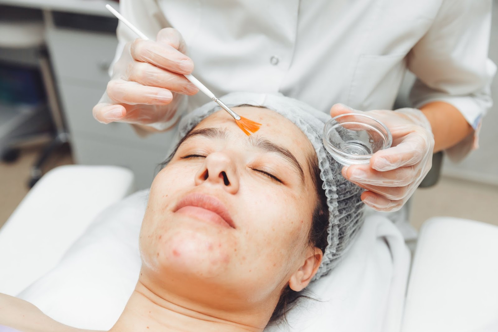 Chemical Peel