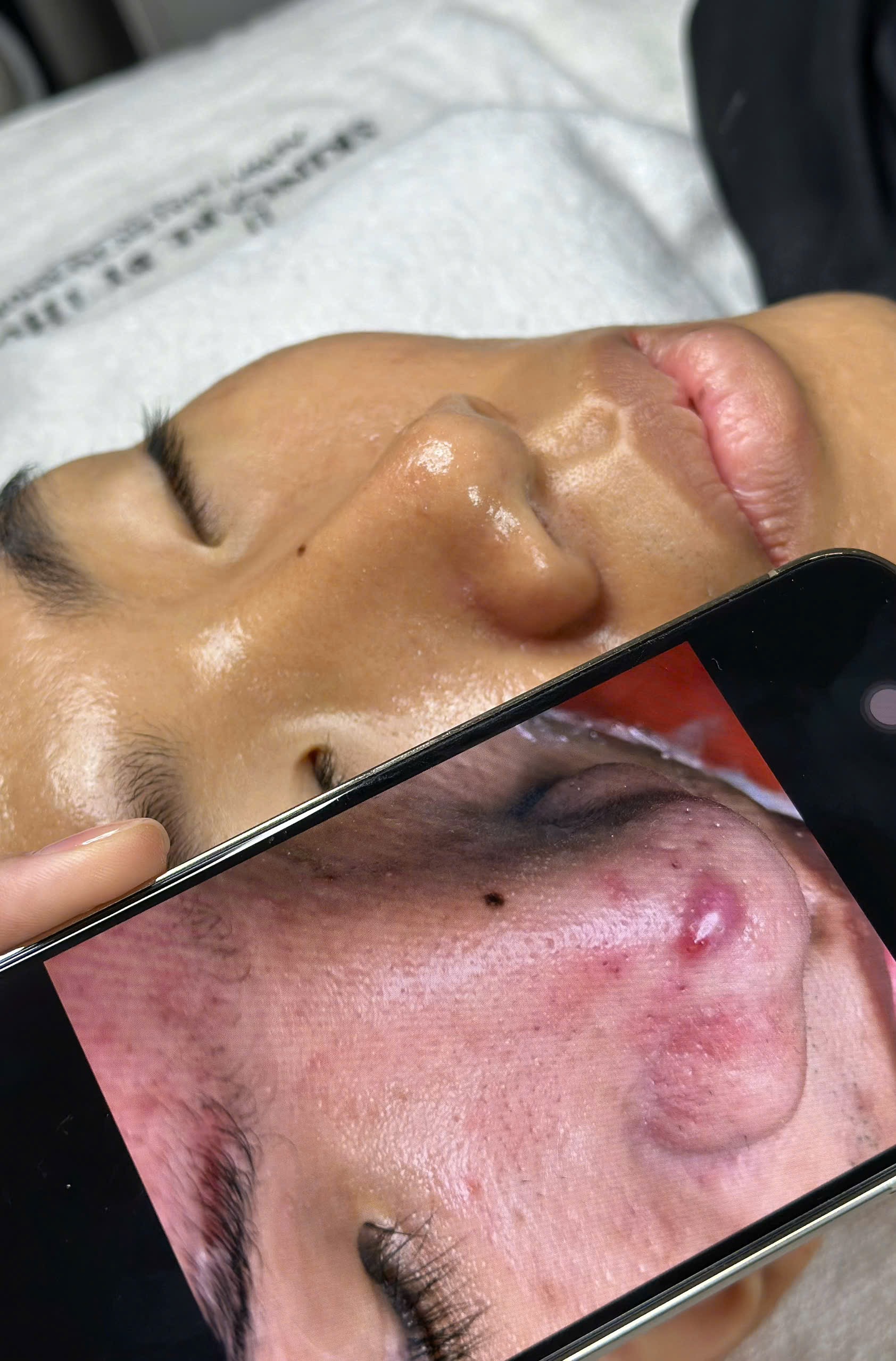 Trị sẹo rỗ bằng laser