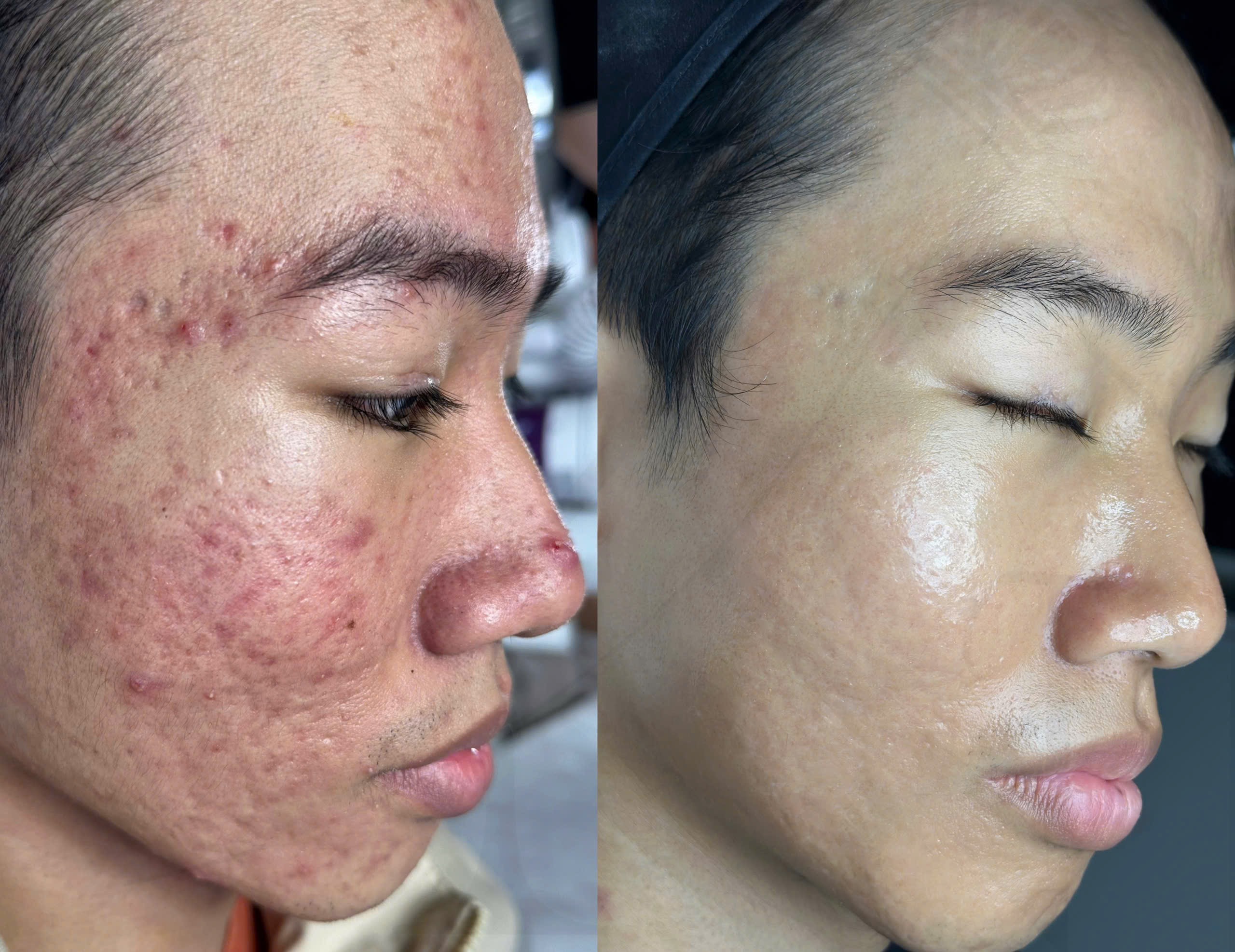 Trị sẹo rỗ bằng laser