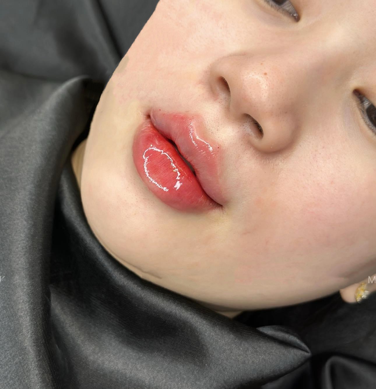 Dịch vụ tiêm Filler