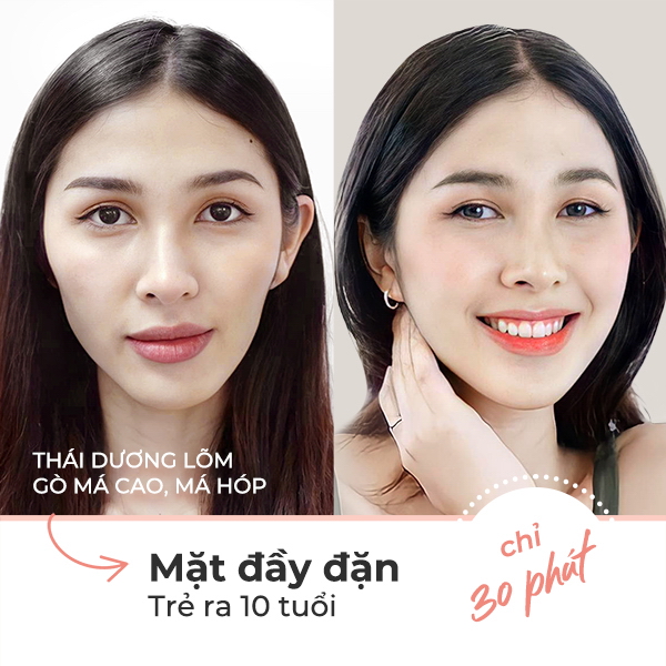 Làm đầy thái dương