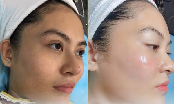 Công nghệ Mesotheraphy giúp căng bóng da