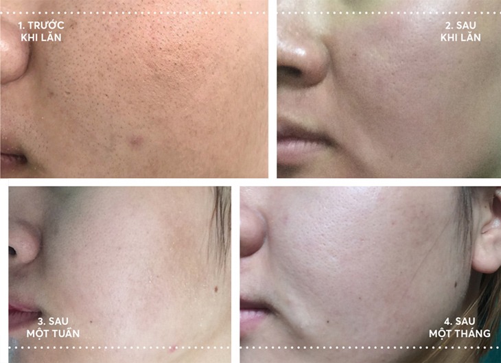Thẩm mỹ viện trị nám