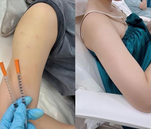 Dịch vụ tiêm tan mỡ