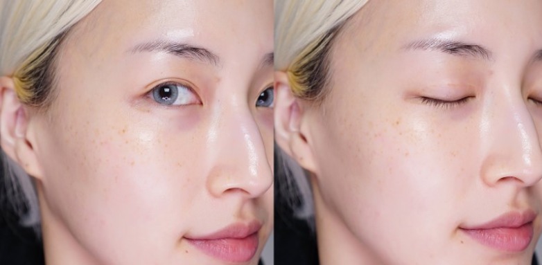 Thẩm mỹ viện trị nám tận gốc uy tín
