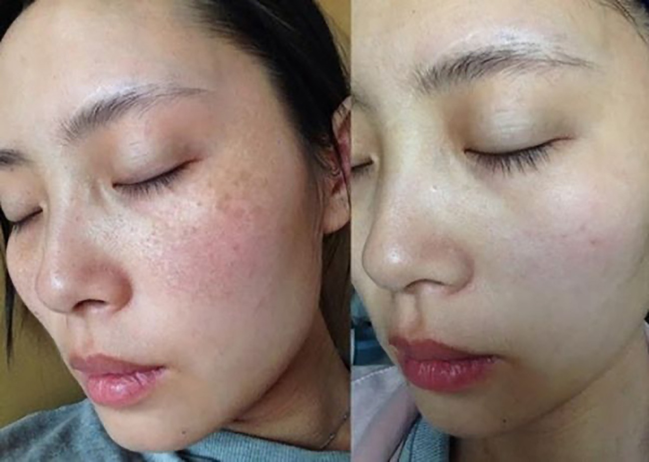Thẩm mỹ viện trị nám