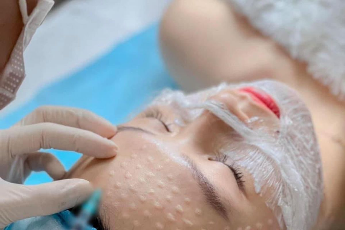 Tiêm meso trị thâm nám gần đây