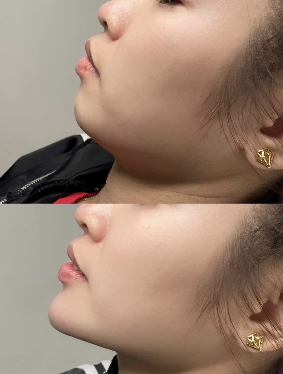 Tiêm tan mỡ nọng cằm