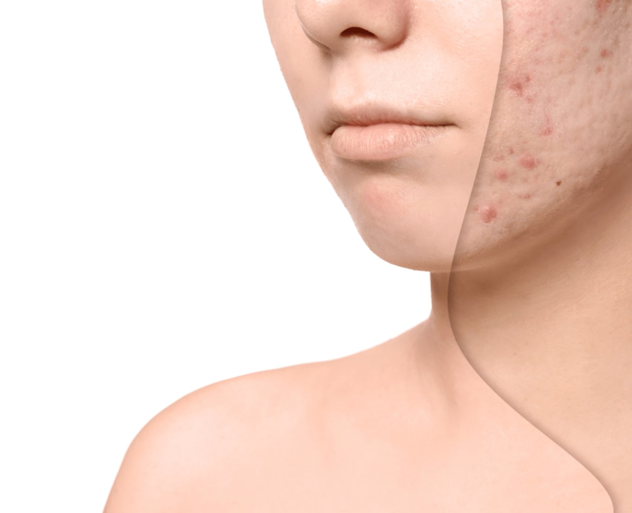 Trị sẹo rỗ ở đâu hiệu quả?
