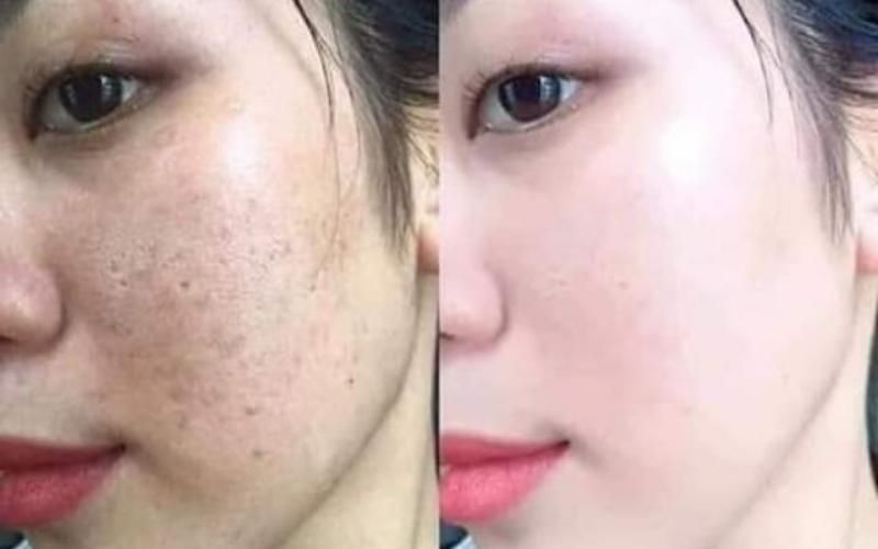 laser trị nám