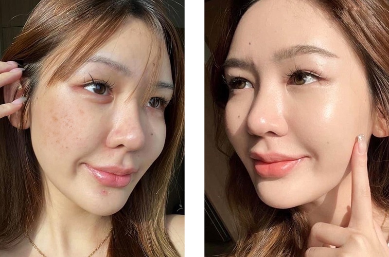 Địa chỉ tiêm meso căng bóng da uy tín