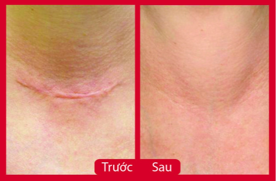 điều trị sẹo lồi