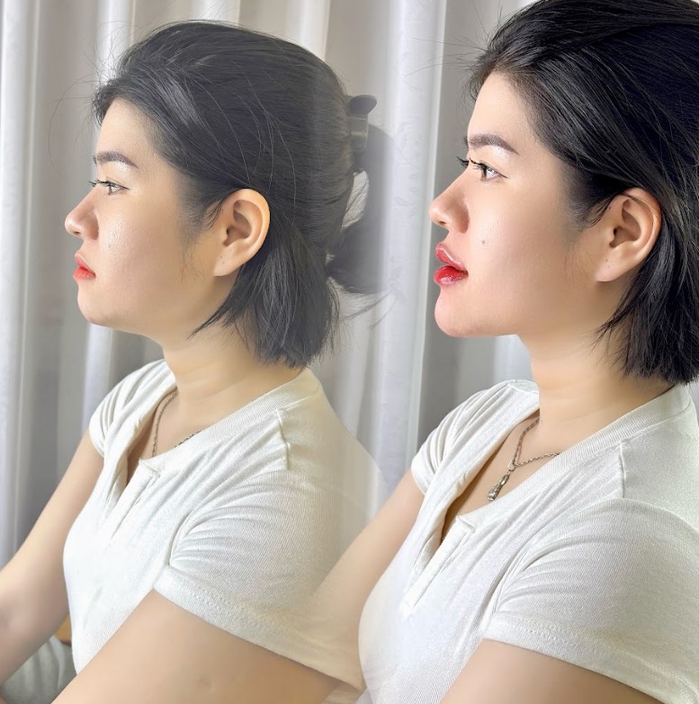 Địa chỉ tiêm filler uy tín