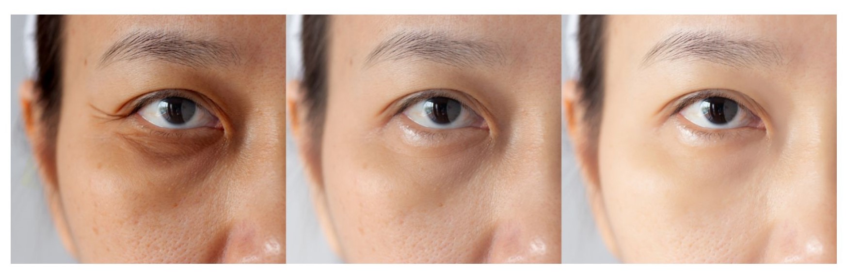 Điều trị khử thâm mắt