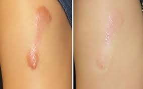 Điều trị tan sẹo lồi