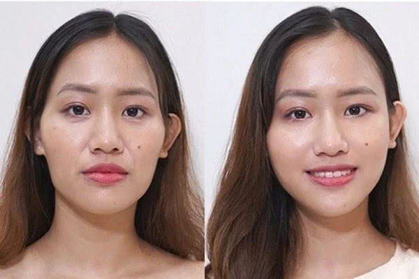 khắc phục thái dương hóp