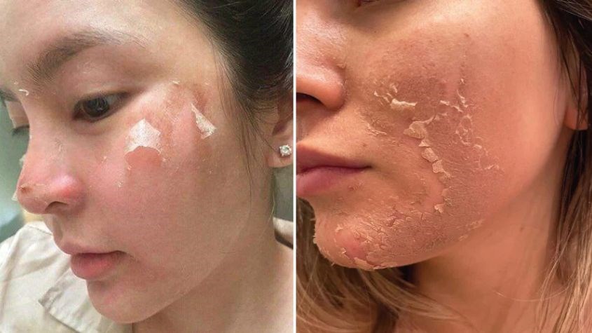 peel da trị mụn tận gốc