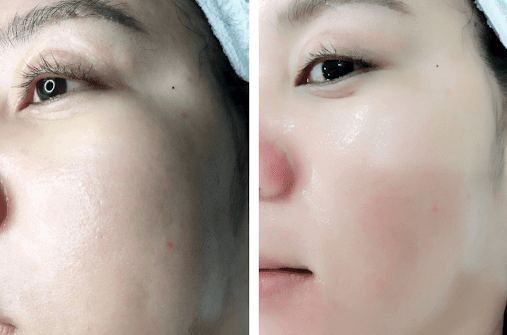 Địa chỉ tiêm HA
