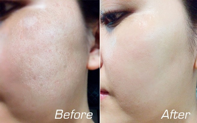 trị sẹo rỗ