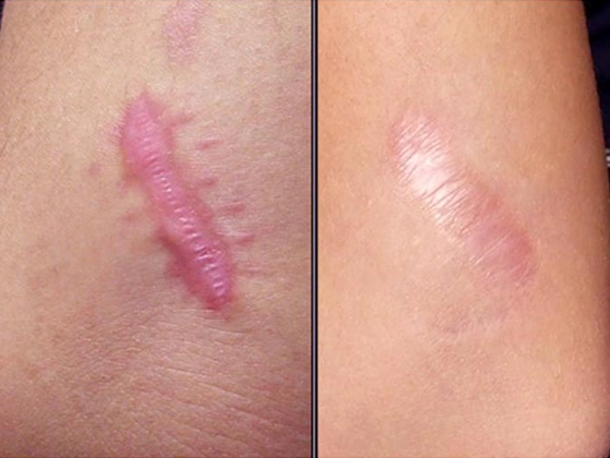 Điều trị tan sẹo lồi