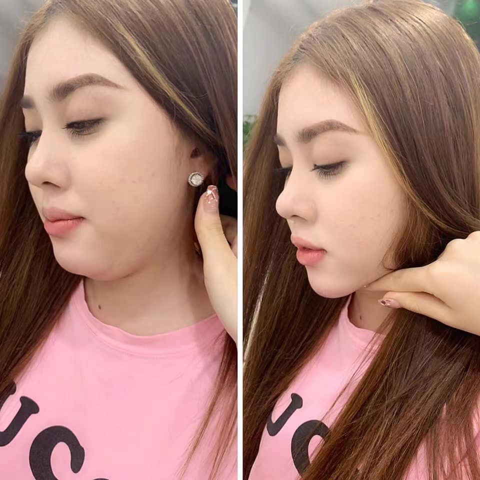 tiêm tan mỡ nọng cằm