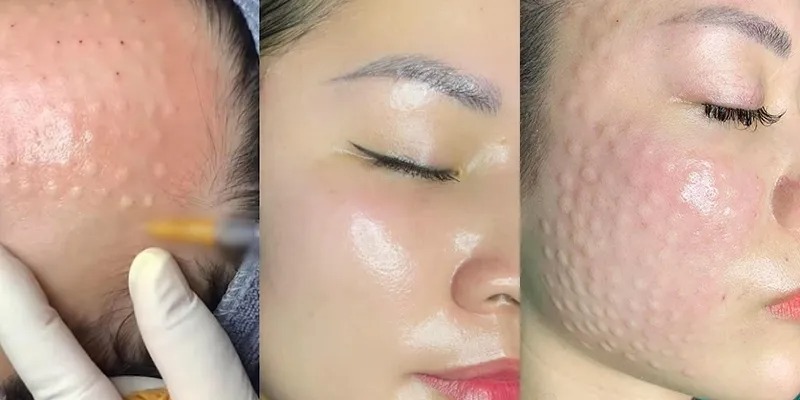 Địa chỉ tiêm HA
