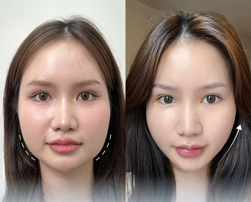 tiêm filler thon gọn mặt