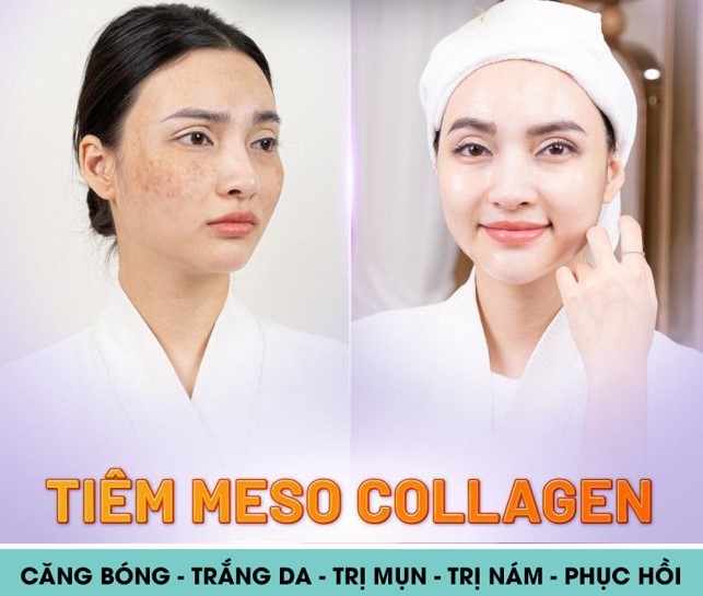 dịch vụ tiêm meso