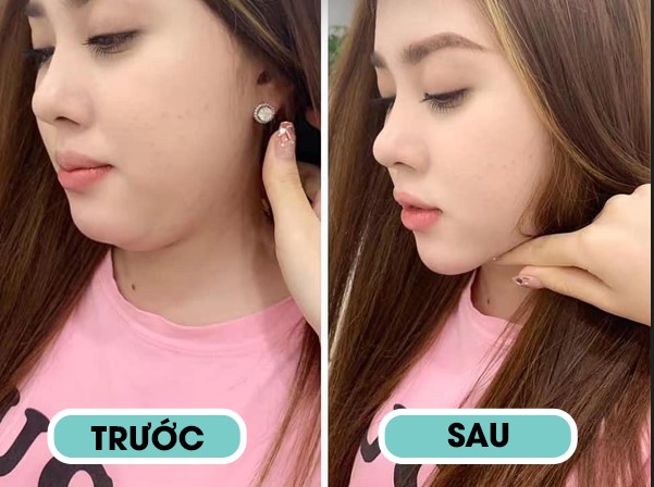 Đánh tan mỡ nọng cằm chỉ với 1 liệu trình