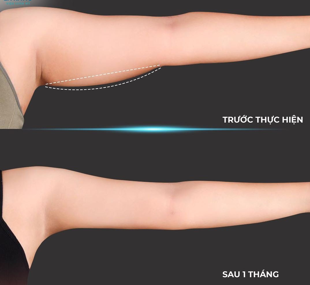tiêm tan mỡ
