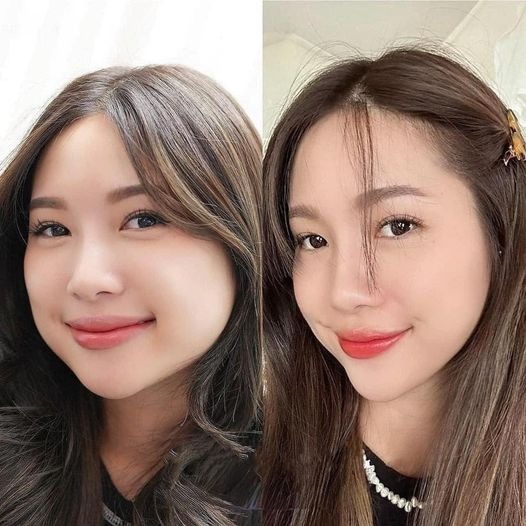 tiêm filler thon gọn mặt