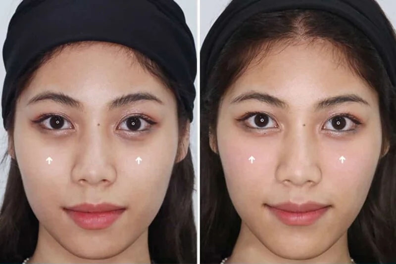 Điều trị khử thâm mắt