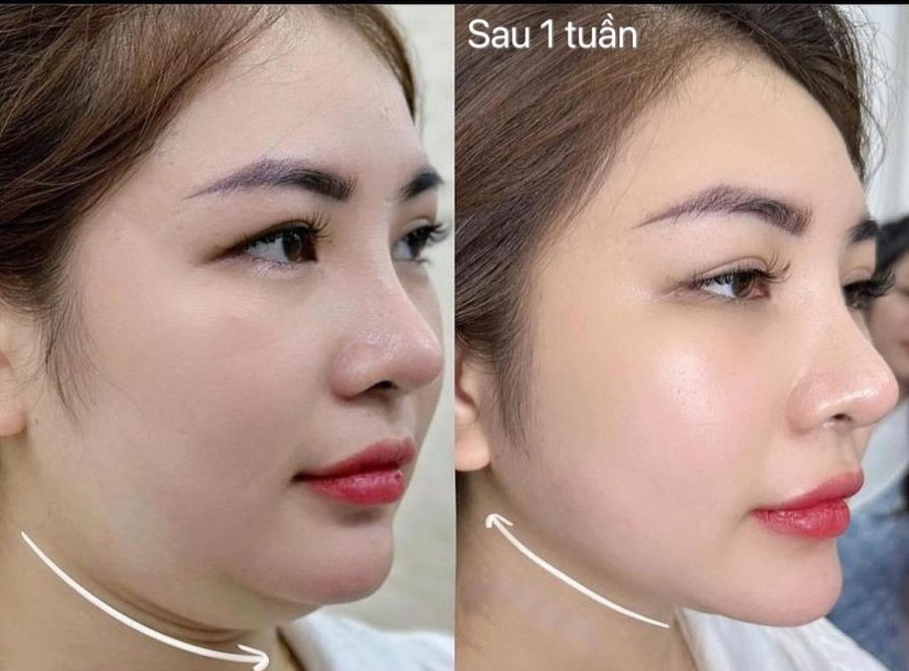 Tiêm tan mỡ nọng cằm