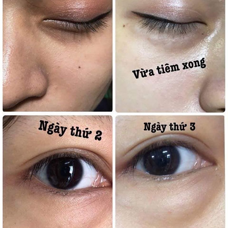 trị thâm mắt