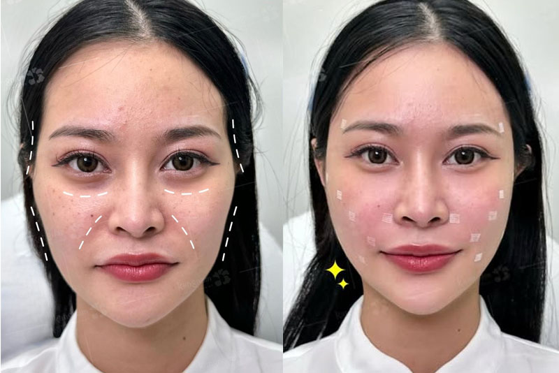 Giải pháp khắc phục thái dương hóp tại viện KW Clinic