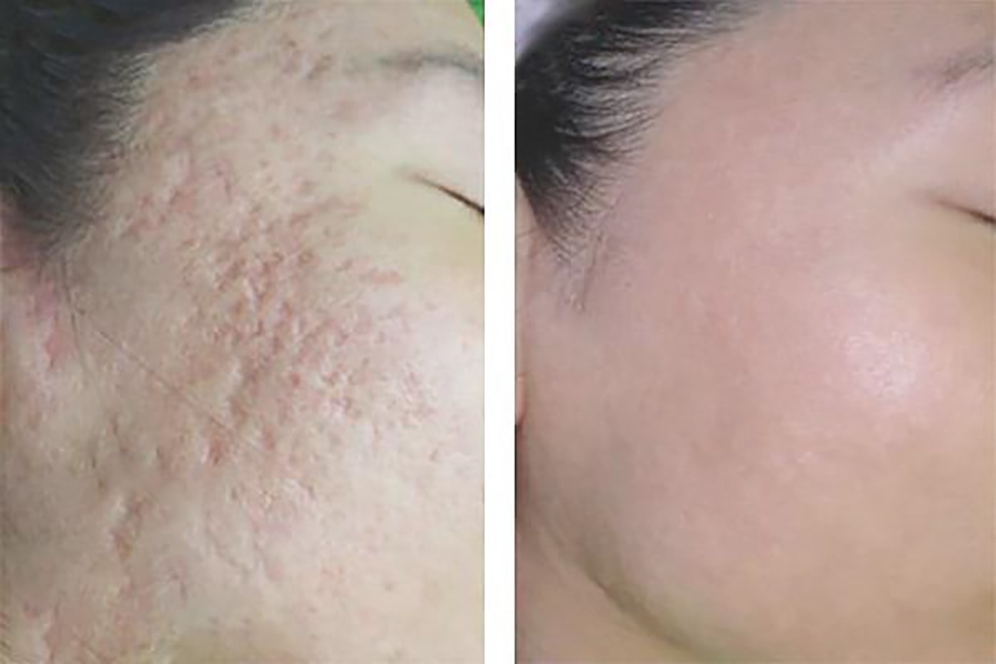 trị sẹo rỗ